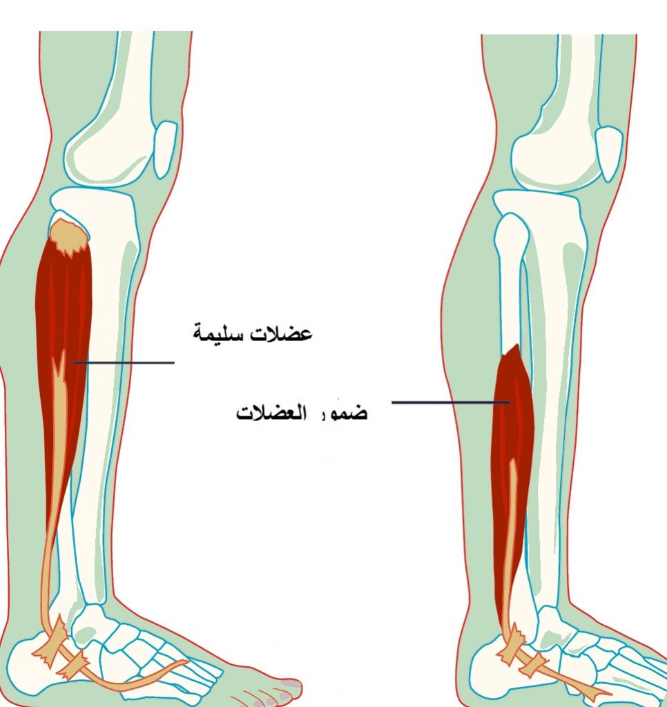 مرض ضمور العضلات أسبابة طرق علاجة
