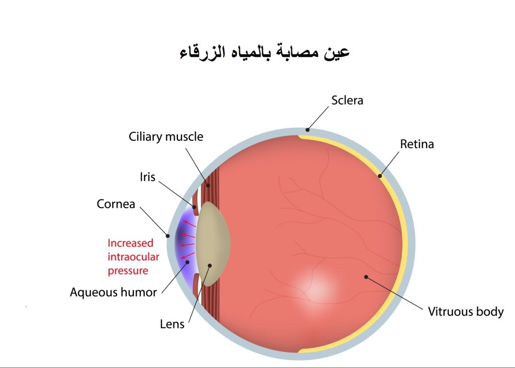 مرض المياه الزرقاء فى العين وطرق علاجه