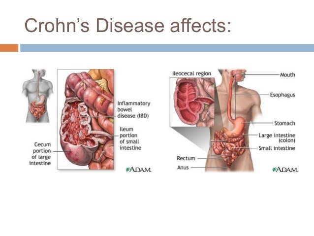 علاج مرض كرون
