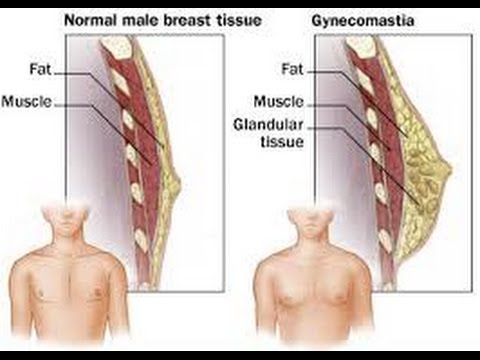 Photo of تضخم الثدي عند الرجال اسبابه وطرق علاجه