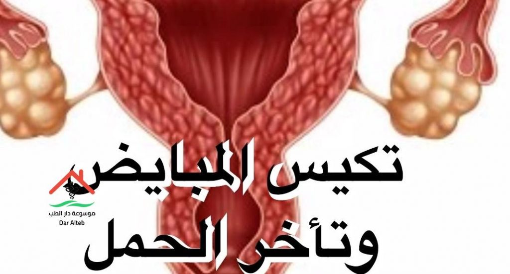 أعراض تكيس المبايض البسيط وطرق العلاج