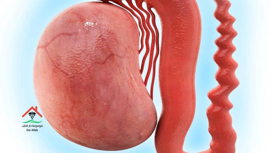 عملية دوالي الخصيتين