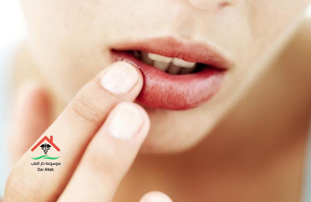 علاج التهاب الشفايف