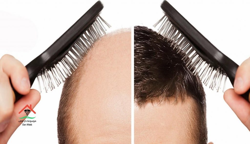 زراعة الشعر