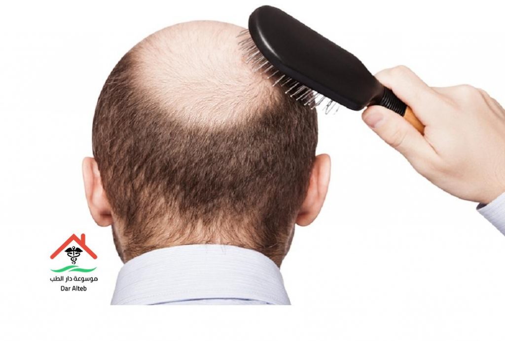زراعة الشعر الطبيعي