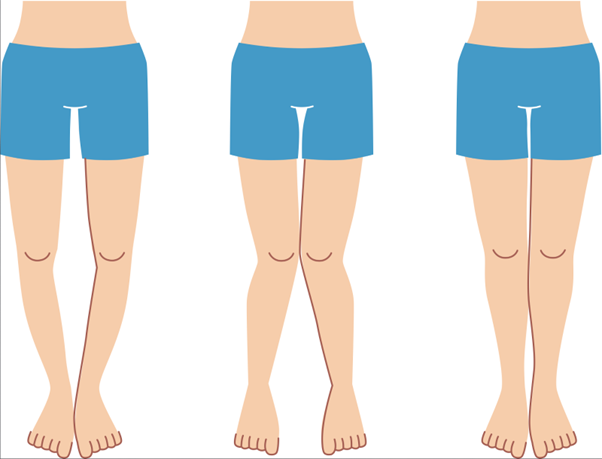 علاج تقوس الساقين